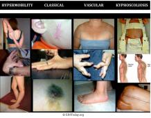 EDS TODAY ~ Ehlers-Danlos Advocates 